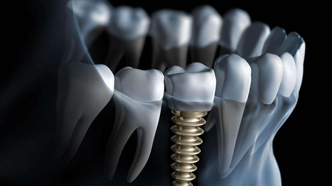DENTAL IMPLANTS & PERIODONTAL HEALTH | Best Dental Implant in Rochester, NY