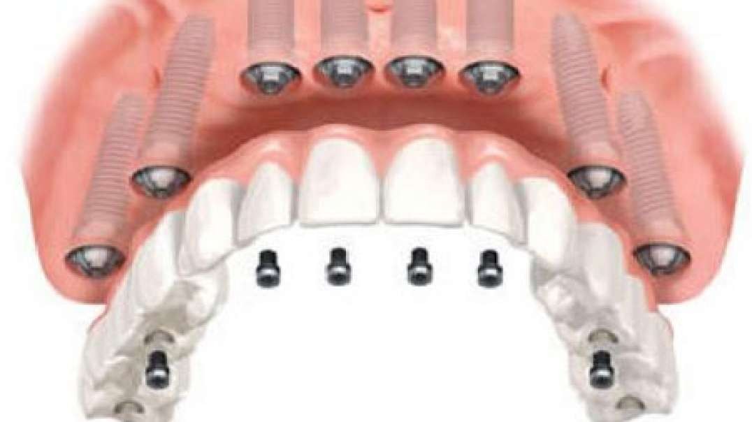 Smile Plus : All ON 6 Dental Implants in Homestead, FL