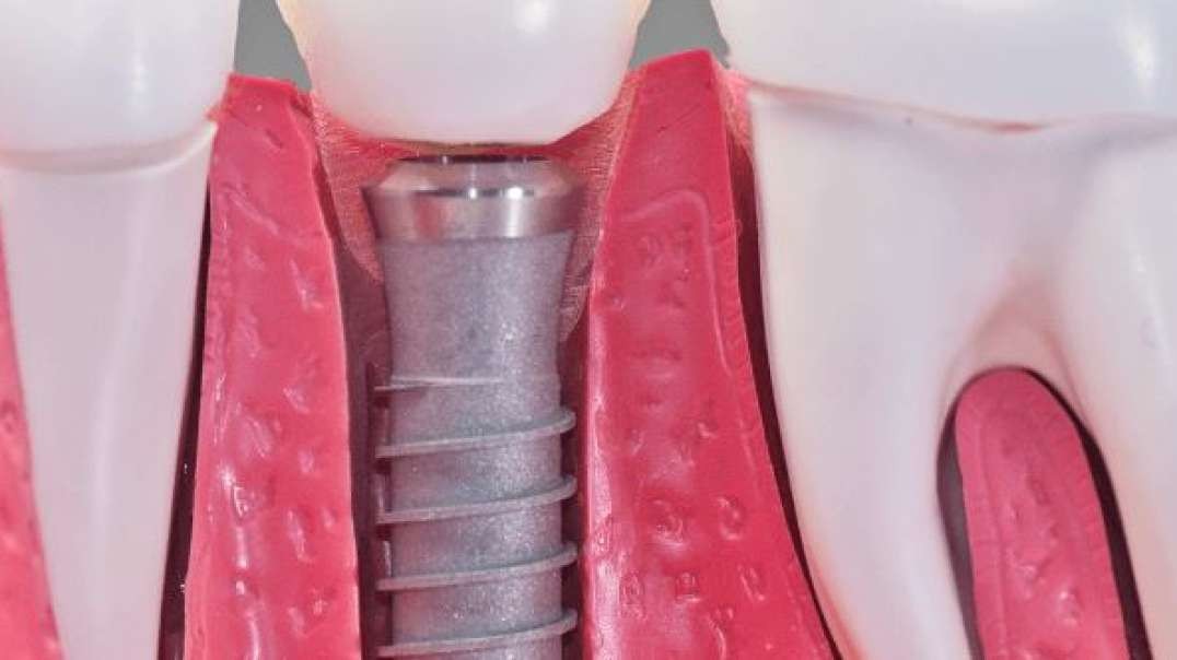 Comfy Smile Dental : Dental Implants in Davie, FL