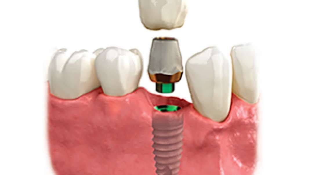 Smile Plus : Dental Implants in Homestead, FL | 33030