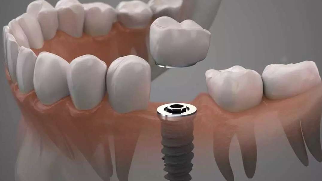 DB Dental Care : Dental Implant in Miami, FL : 33165